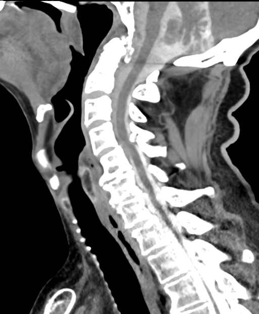 CT MYELOGRAM [CRANIO-CERVICAL]